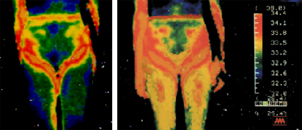 アルファウェーブ：サーモグラフィーによる検査