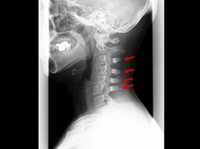 頸レントゲン