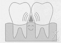 歯間部に適した形態説明図:断面が三角