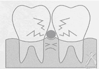 歯間部に適していない形態説明図:断面が丸