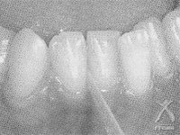 使用写真：歯間形態に合わせてサイズを選びましょう