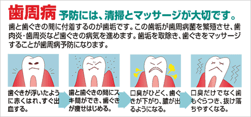 歯周病予防には、清掃とマッサージが大切です。歯と歯茎の間に付着するのが歯垢です。この歯垢が歯周病菌を繁殖させ、歯肉炎・歯周炎など歯茎の病気を進めます。歯垢を取り除き、歯茎をマッサージすることが歯周病予防になります。「歯茎が浮いたように赤く腫れ、すぐ出血する→歯と歯茎の間に隙間ができ、歯茎が痩せはじめる。→口臭がひどく、歯茎が下がり、膿が出るようになる。→口臭だけでなく歯もぐらつき、抜け落ちやすくなる。」